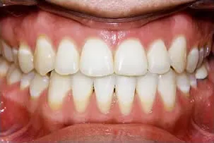 los-angeles-orthodontics-smiles-1-after porcelain veneers smile two after