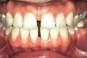 los-angeles-orthodontics-smiles-1-before porcelain veneers smile two before