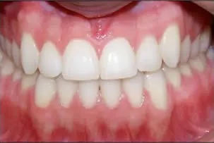 los-angeles-orthodontics-smiles-2-after porcelain veneers smile three after