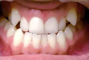 los-angeles-orthodontics-smiles-2-before porcelain veneers smile three before