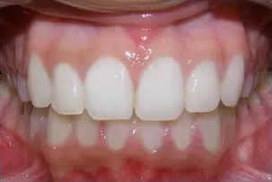 los-angeles-orthodontics-smiles-3-after dental crowns after