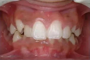 los-angeles-orthodontics-smiles-3-before dental crowns before