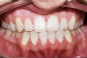 los-angeles-orthodontics-smiles-8-after