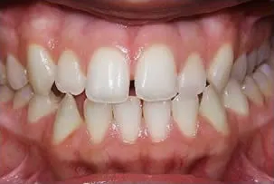 los-angeles-orthodontics-smiles-8-before